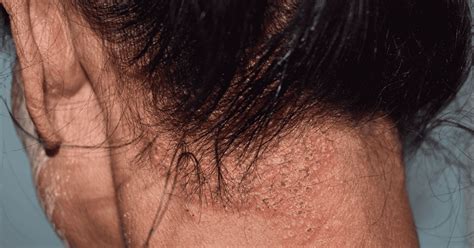 皮膚病|Skin Disorders: Pictures, Causes, Symptoms, and Treatment